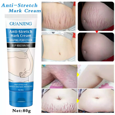 Guanjing Anti-Stretch Mark Cream