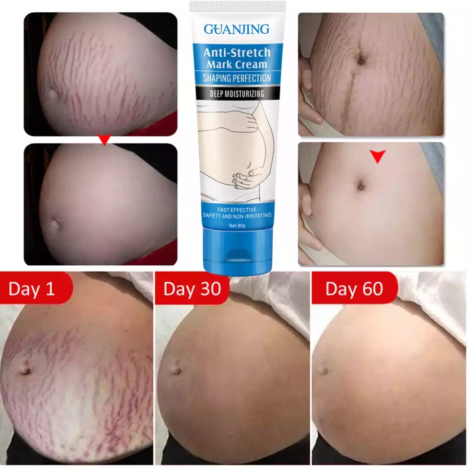 Guanjing Anti-Stretch Mark Cream